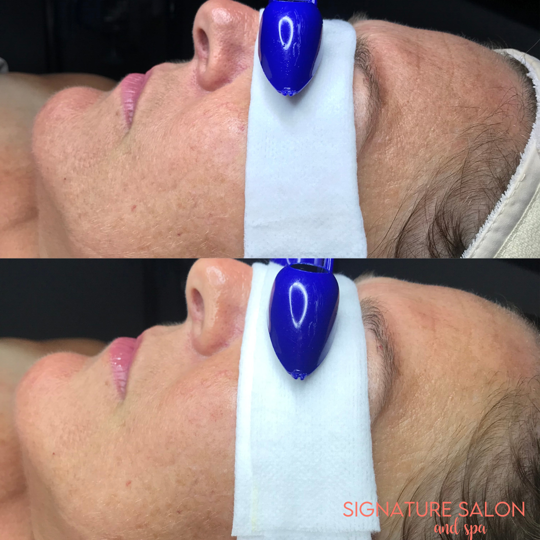 Signature Spa Facial Before and Immediately After Waukesha